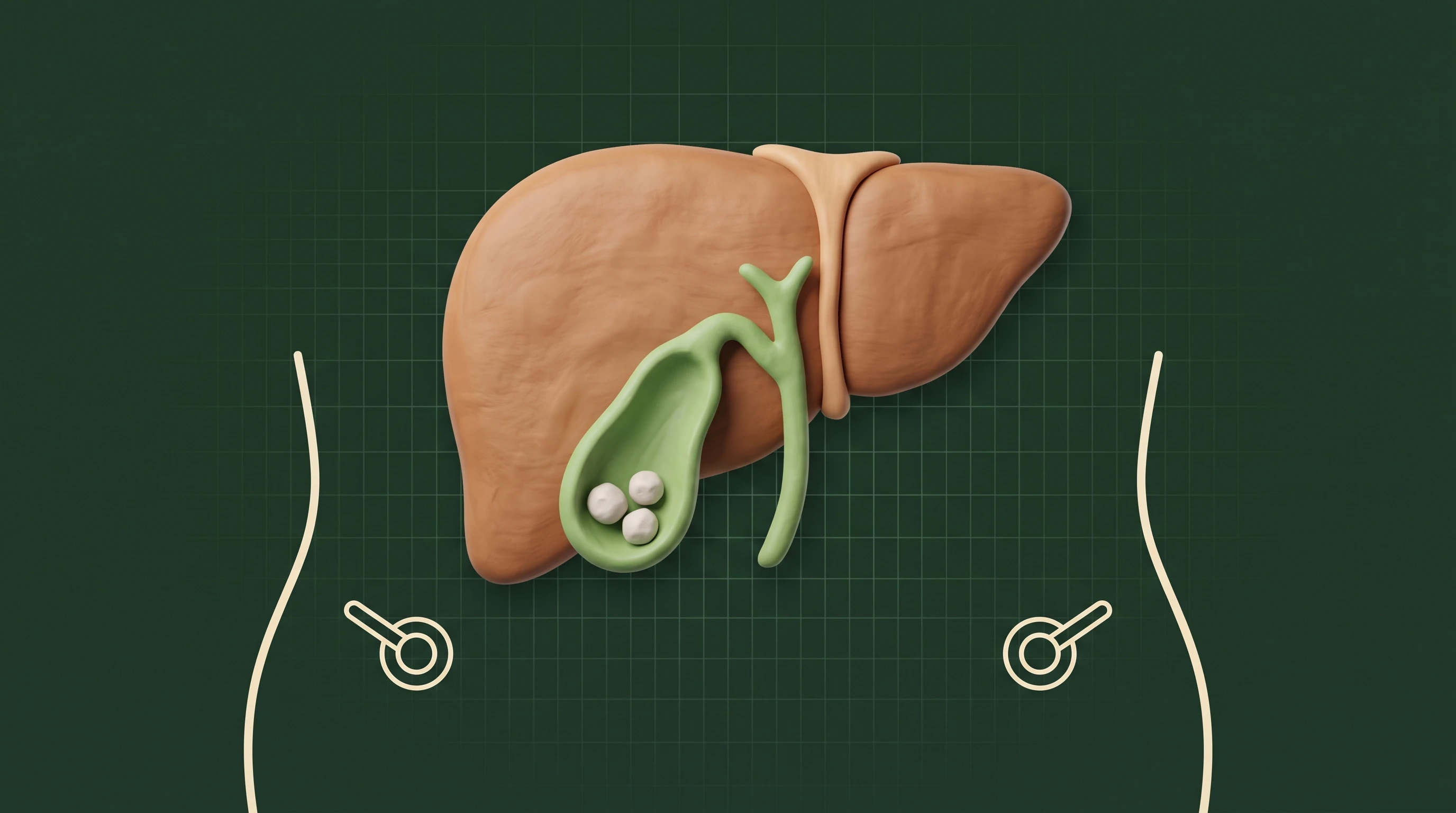 Ilustración de un hígado con la vesícula y sus piedras, sobre el contorno de un abdomen con los puertos de laparoscopía